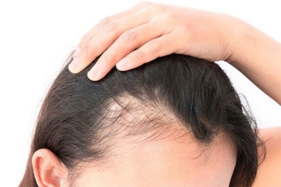 دلایل ریزش شدید مو در زنان و مردان چیست؟